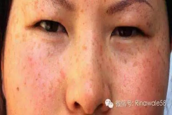 瑞倪维儿透明质酸凝胶可以祛斑吗（瑞倪维儿来帮你）.