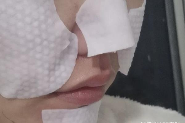 刷酸之后正确的护肤步骤（刷酸需要和护肤一起进行吗）.