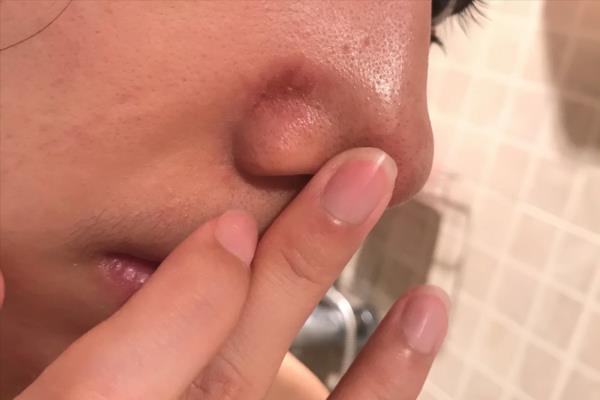 壬二酸真的能去黑头吗（想要告别草莓鼻）.