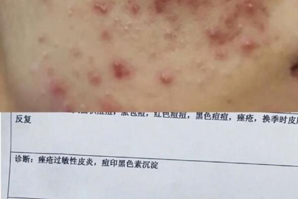 痘坑修复用什么护肤品比较好（痘痘痘印严重不要怕~可以用这些护肤品）.