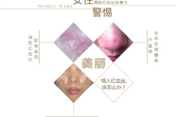 光子嫩肤去红血丝一般多少钱一次（想要告别红血丝）.