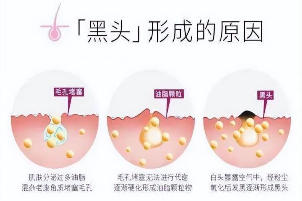可以用去黑头的产品吗（想要告别草莓鼻）.