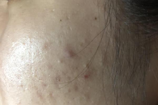 爱起痘痘用skii还是海蓝之谜护肤品.