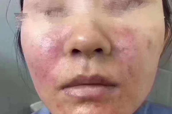 为什么用lamer激素脸会复发.