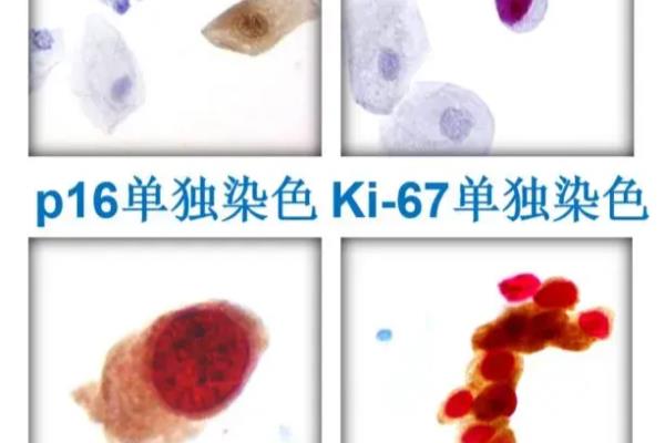 宫颈p16ki67双染检测是什么.