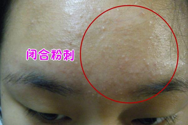 脸上长小包包不痛不痒怎么办.