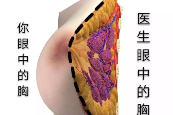 假体隆胸胸下面有个鼓包怎么回事