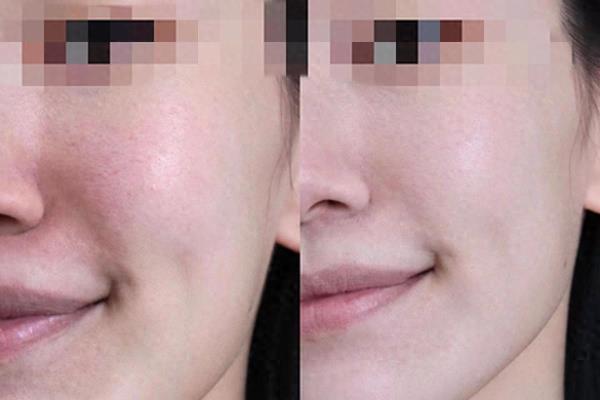 柳丝木隔离成分安全吗.