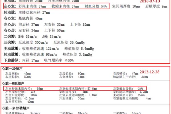 心脏彩超lv变小正常吗