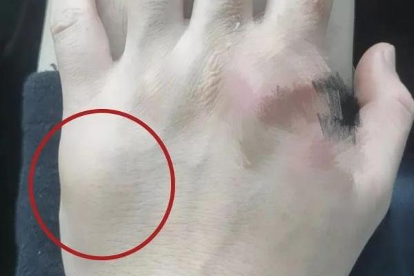 手上莫名起包是什么原因